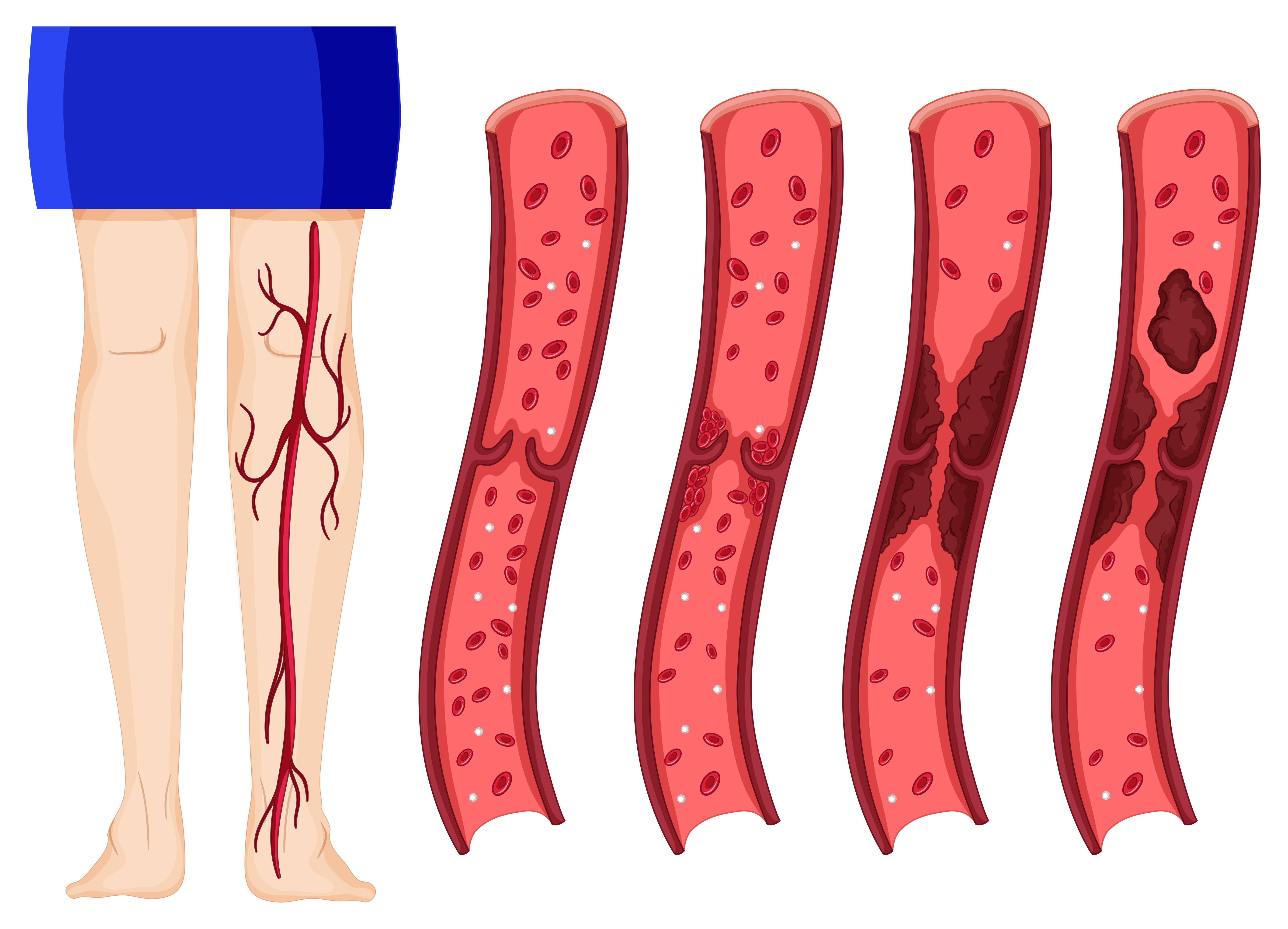 eep vein thrombosis (dvt)