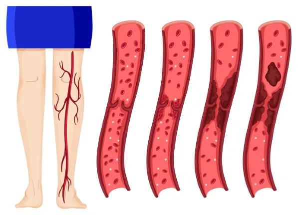 eep vein thrombosis (dvt)