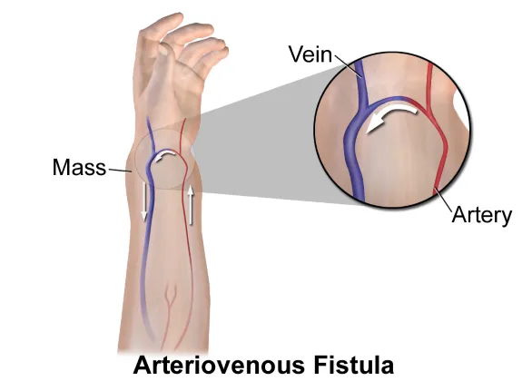 dialysis fistual