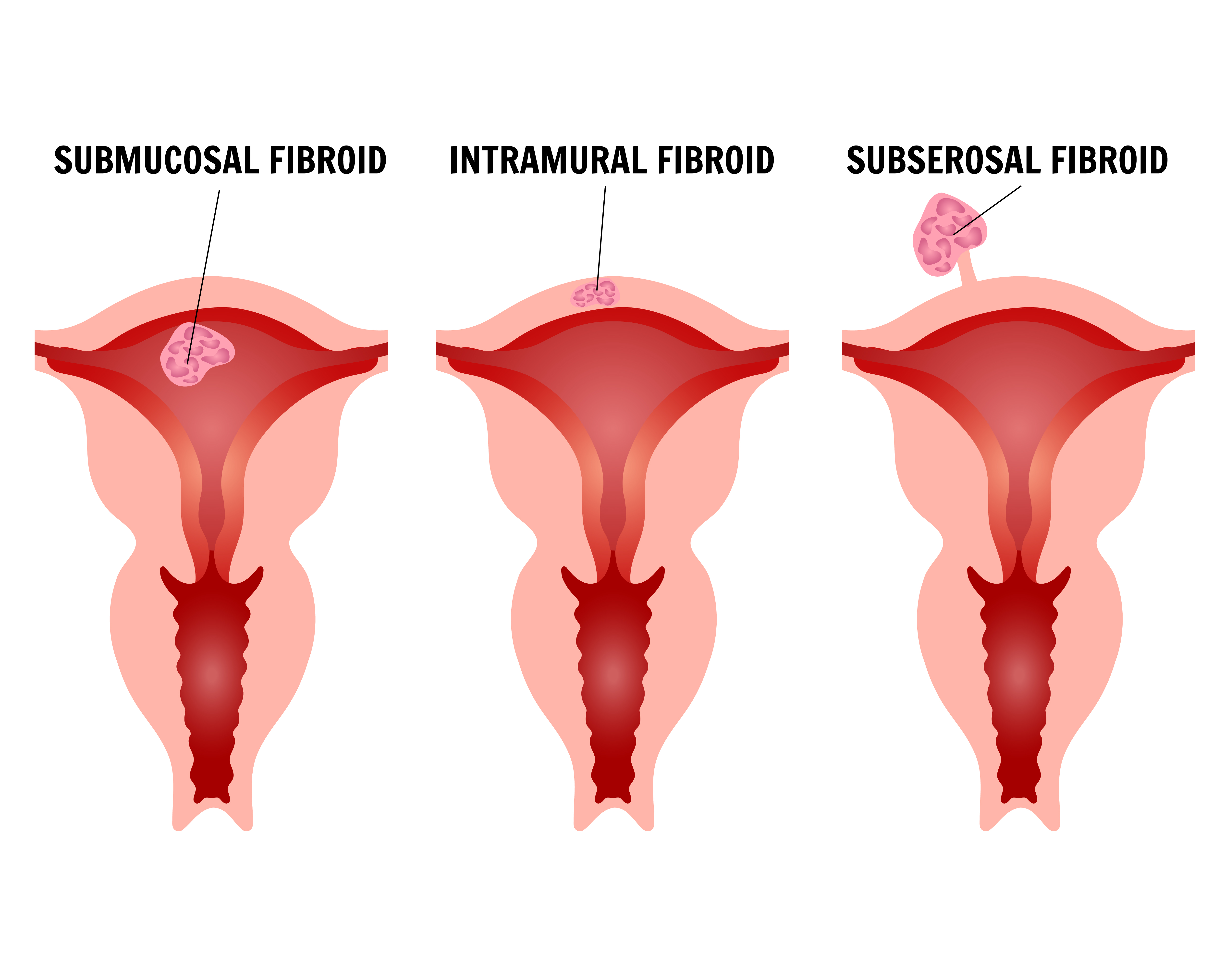 utrtine fibroids