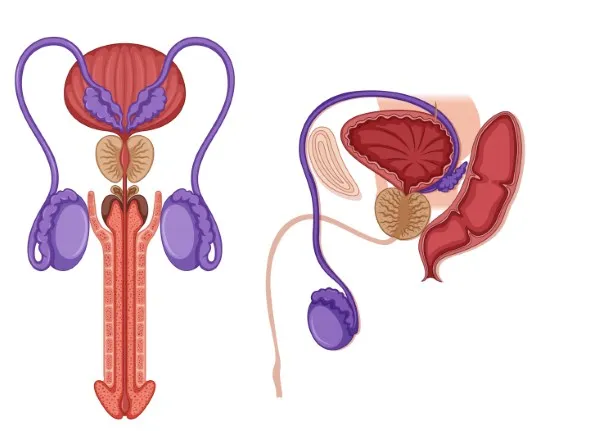 varicocele