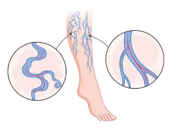 varicocele vein