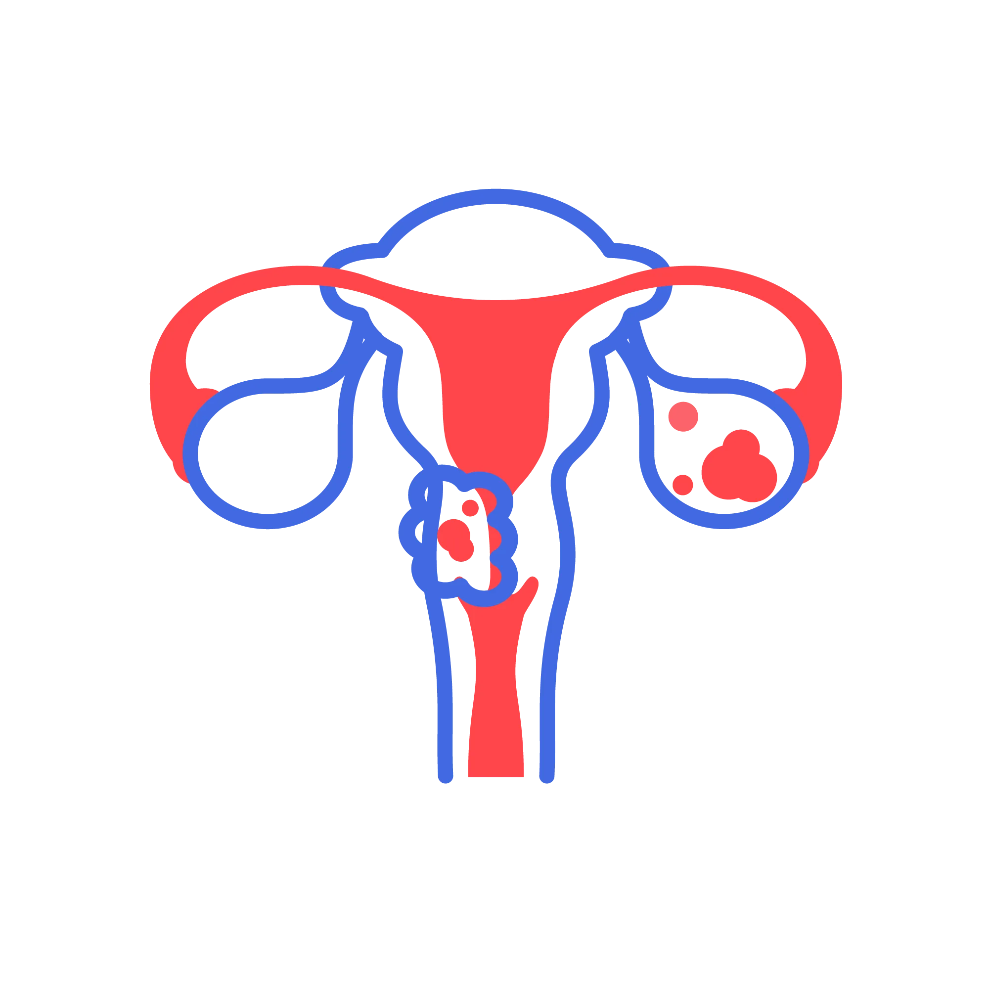 utrtine fibroids