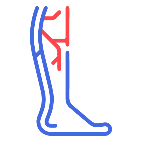 varicocele vein